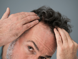 Marijuana and Hair Loss