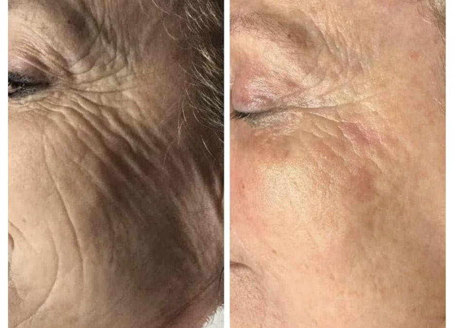 Plasma Fibroblast Client (10).jpg