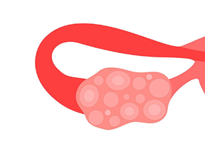 Síndrome do ovário policístico (SOP): O que você precisa saber