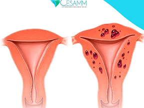 O que é adenomiose?