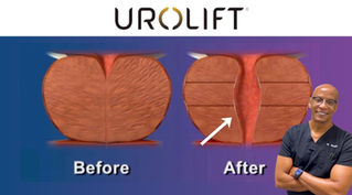 BPH Treatment UroLift