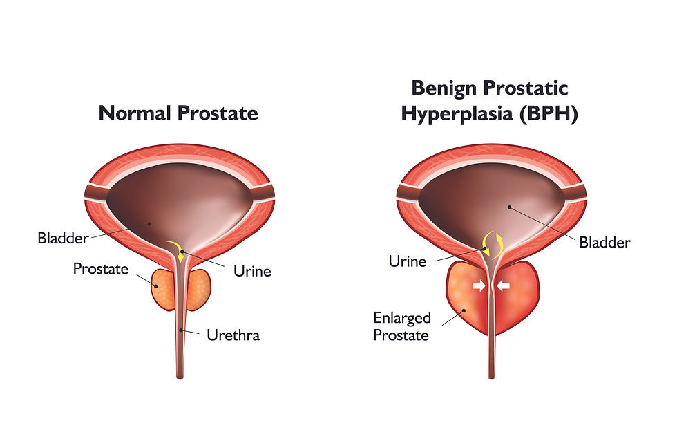 BPH prostate enlarged (Benign prostatic hyperplasia) urine bladder and prostate