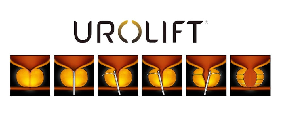 urolift procedure