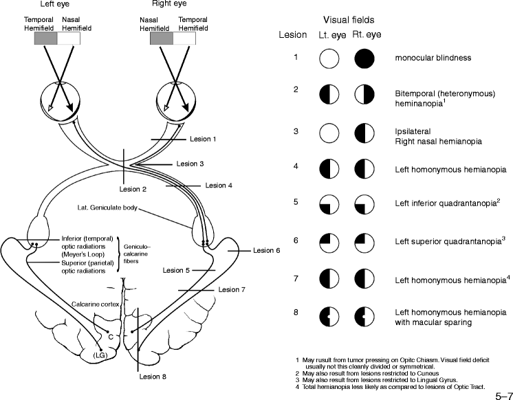 VISUAL FIELD DEFECTS AS PER SITE OF CN2 INJURY