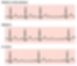 Second_degree_heart_block