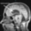 Syringomelia and type 2 Arnold Chiari MRI- T1(fluid black,fat-white matter is white)