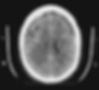 Subdural hematoma-CT scan 2