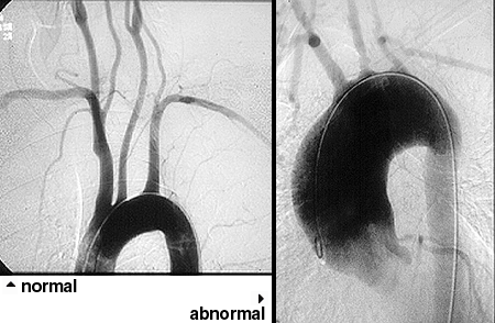 Takayasu arteritis angiography