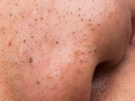 How to get rid of blackheads instantly