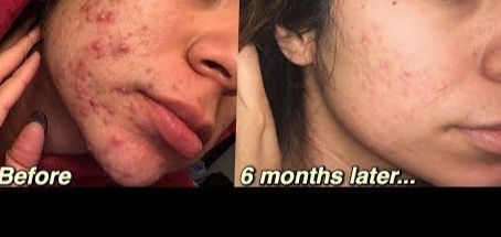 Accutane