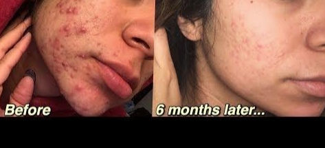 Accutane