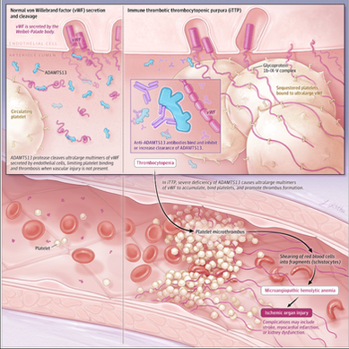 Immune Thrombotic Thrombocytopenic Purpura A Review