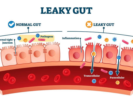 Leaky Gut Syndrome - What's Going On With Your Gut?