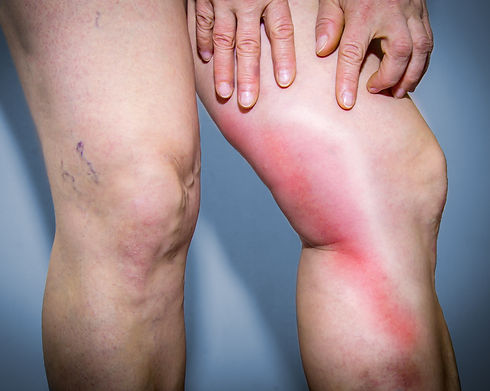 Phlebitis leg.jpeg