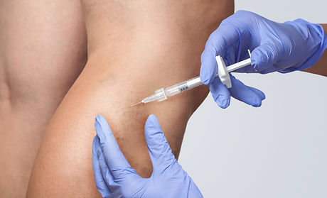 Microsclerotherapy.jpeg