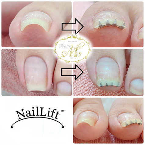 Preventative Nail Care for Nail Technicians: Where Aesthetics Ends and Medical Begins