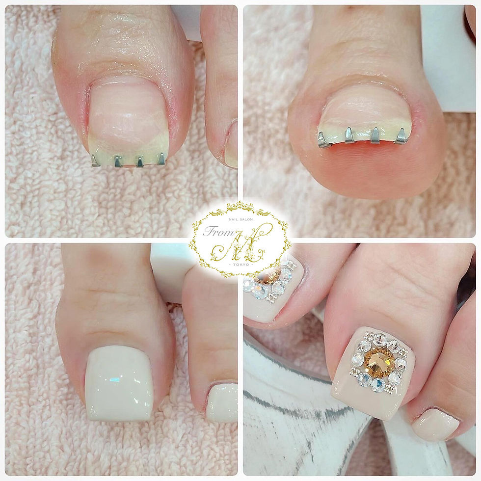 Why Nail Bracing Is Emerging in Professional Nail Care