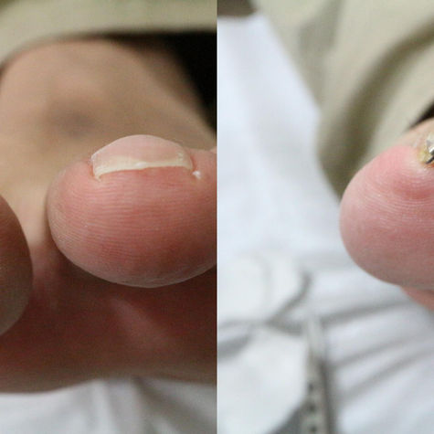 Correcting Curved Nails Without Removing the Nail