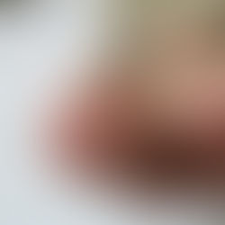 Selecting the Right Patients for Conservative Nail Bracing