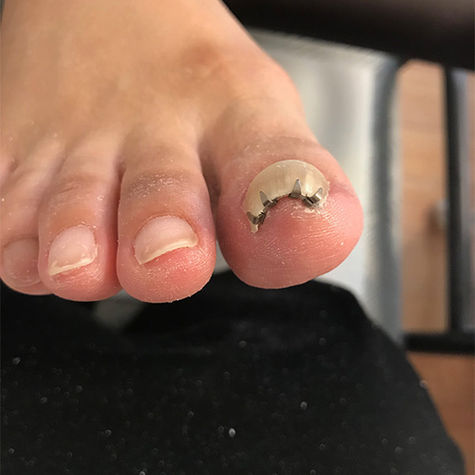 Correcting Nail Shape: From Curved to Gel-Ready