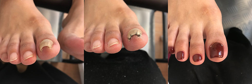 Nail bracing progression showing involuted toenail, brace application, and finished red acrylic nail result