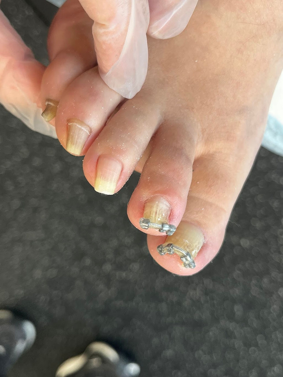 Conservative ingrown toenail management using NailLift nail bracing system