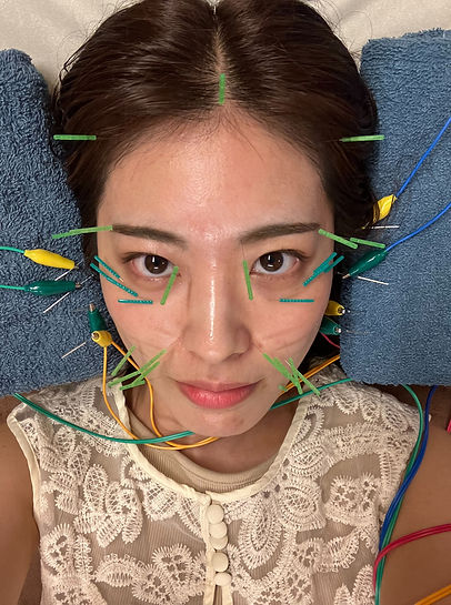 美容鍼を受ける女性