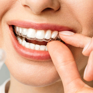 Alineadores Invisalign removibles y transparentes para corrección dental discreta