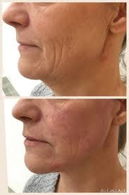 Before and after Meso Filler treatments