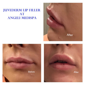 Lip Filler 1 mil Juvederm