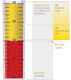 PRP- Platelet Rich Plasma