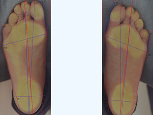 歩くと膝の裏が痛くなるお客様の理由