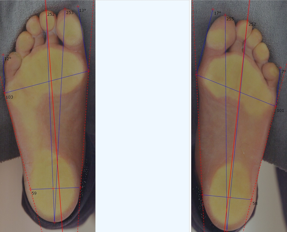 歩くと膝の裏が痛くなるお客様の理由