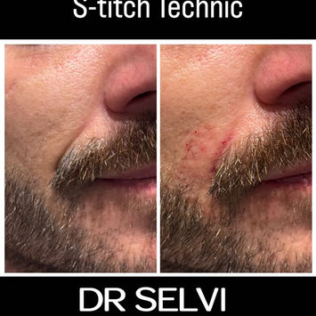 Nasolabial fold filler, before and after – Dr Selvi Clinic, Brighton