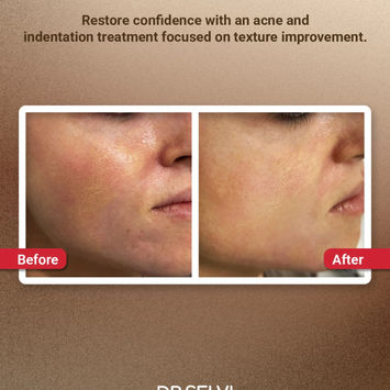 Acne and indentation scarring, texture before and after – Dr Selvi Clinic, Brighton