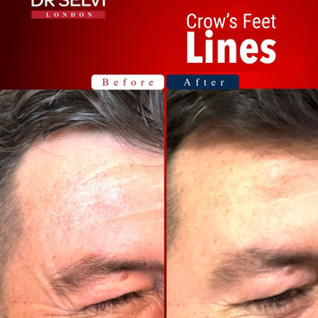 Crow's feet, before and after (anti-wrinkle treatment) – Dr Selvi Clinic, Brighton