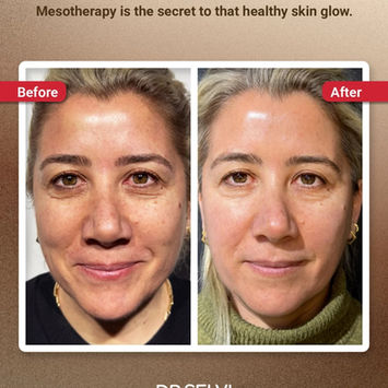 Full-face mesotherapy for glow and hydration – Dr Selvi Clinic, Brighton