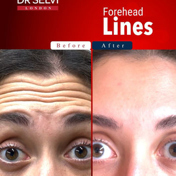Forehead lines, before and after (anti-wrinkle treatment) – Dr Selvi Clinic, Brighton