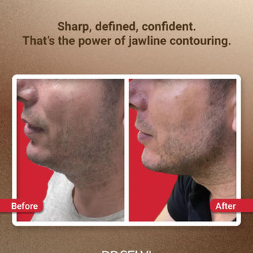 Jawline contouring, side profile before and after – Dr Selvi Clinic, Brighton