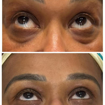 Upper and lower eyelid skin, before and after Plexr – Dr Selvi Clinic, Brighton