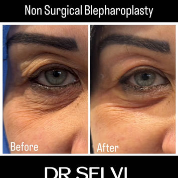 Under-eye fine lines and eyelid skin, before and after Plexr – Dr Selvi Clinic, Brighton