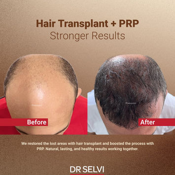 Hair transplant combined with PRP, before and after – Dr Selvi Clinic, Brighton