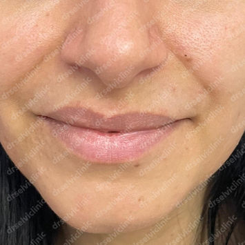 Selvi Pearl protocol for smoothness and radiance – Dr Selvi Clinic, Brighton