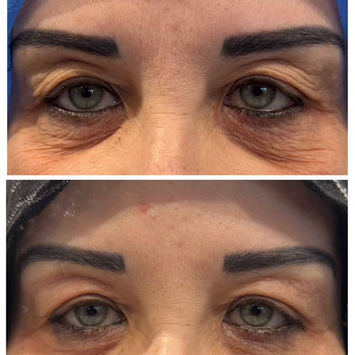 Hooded upper eyelids, before and after Plexr plasma – Dr Selvi Clinic, Brighton