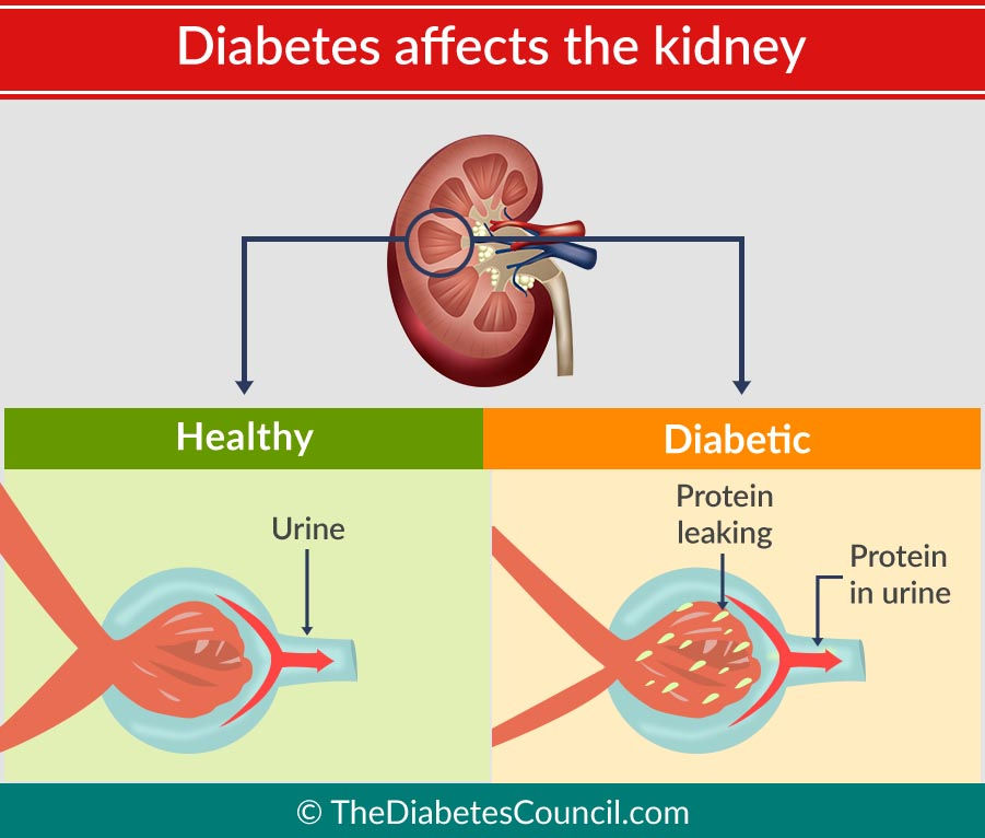 Image demonstrating how diabetes affects kidneys