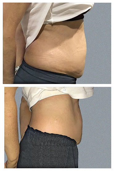 T shock before and after stomach