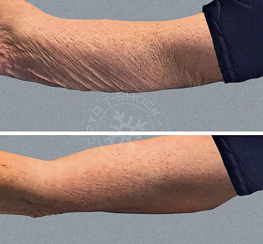 T shock before and after tissue stimulation