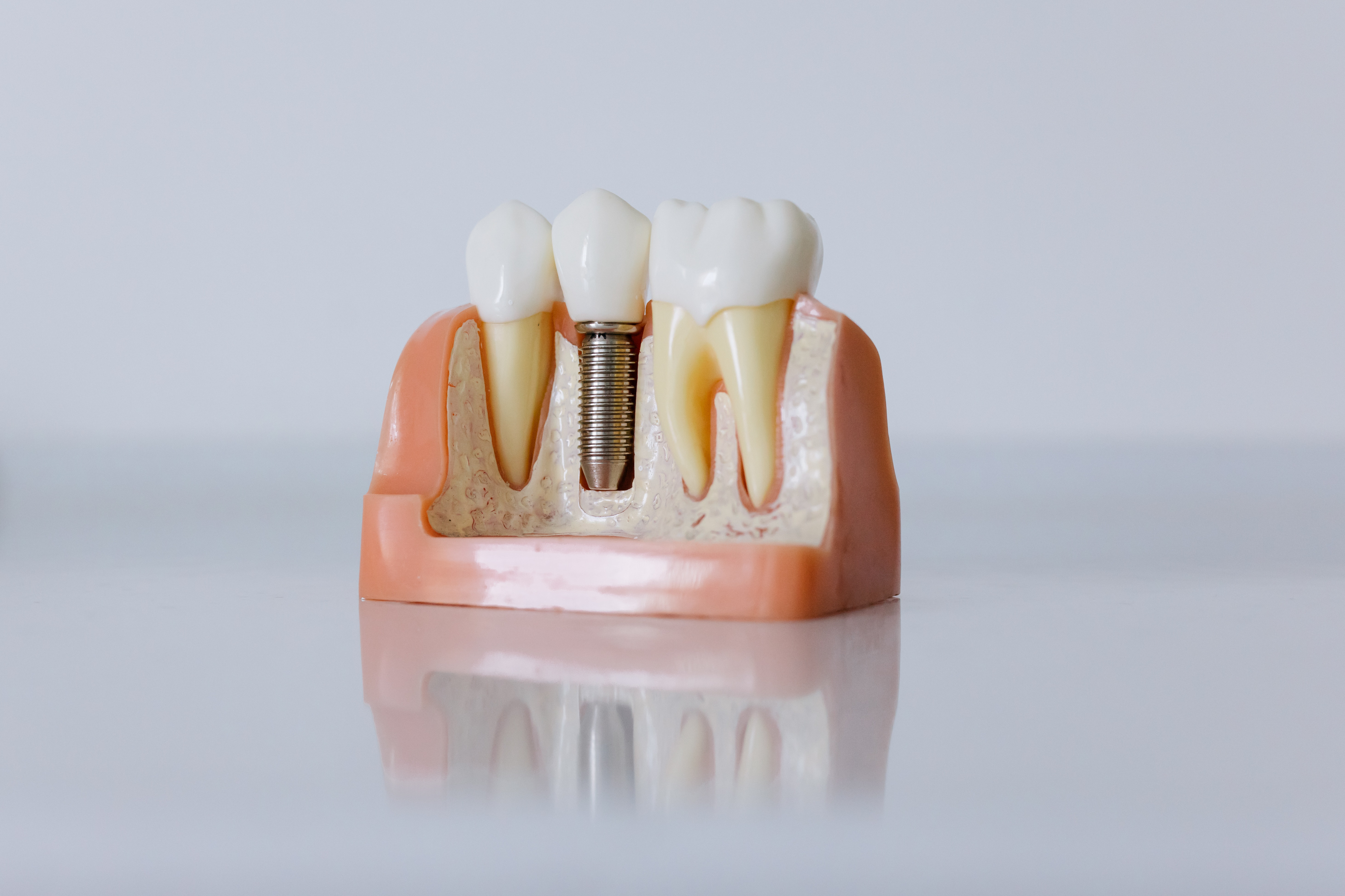 Implantodontia e Cirurgia