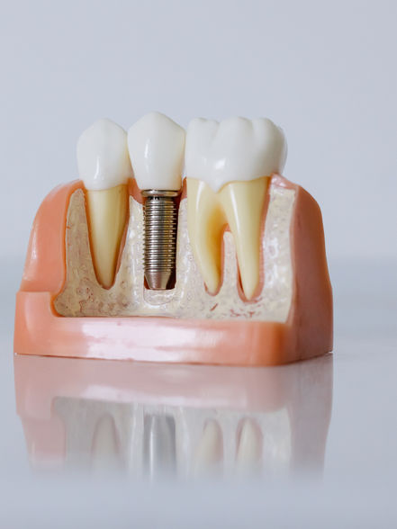 Root Canal