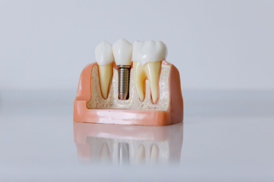 Root Canal